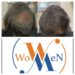 “WowMen Clinic: 10+ Years & 4500+ Satisfied Clients, A Leader in Sustainable Cosmetic Treatments!”