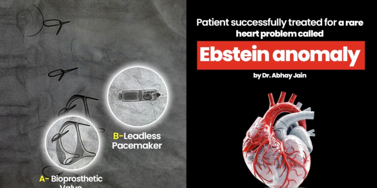 Patient successfully treated for a rare heart problem called Ebstein anomaly by Dr. Abhay Jain