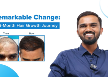 Unlock Your Confidence with VCare’s Revolutionary Hair Regrowth Solution!
