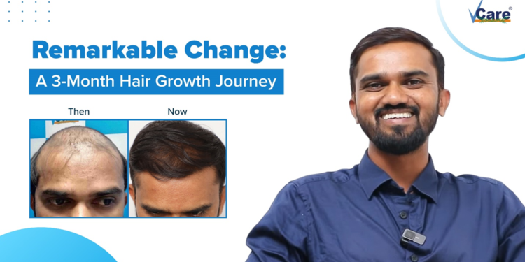 Unlock Your Confidence with VCare’s Revolutionary Hair Regrowth Solution!