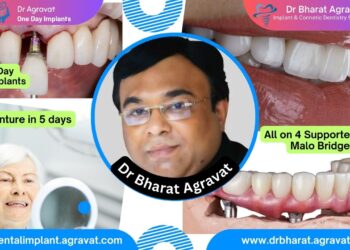 Best Dentist for Full Mouth Dental Implants Clinic in Ahmedabad: Dr. Bharat Agravat, the  top Implantologist.