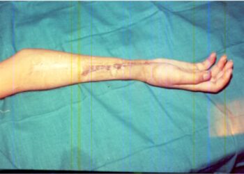 Real-life story: Reconstruction of hand and dramatic recovery