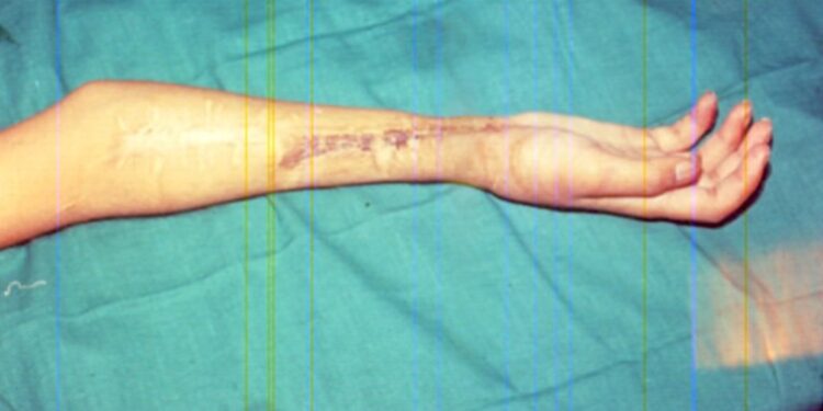 Real-life story: Reconstruction of hand and dramatic recovery